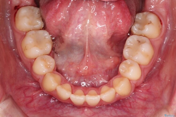ハーフリンガルで目立たず、口ゴボの改善 治療後画像