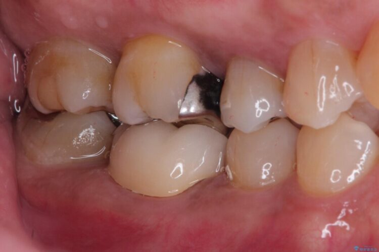 冷たいもので奥歯が痛む。精密根管治療とオールセラミッククラウン 治療後画像