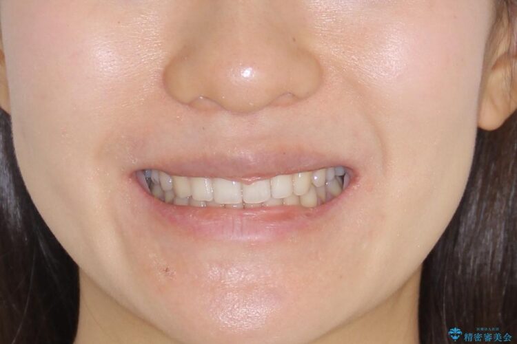 インビザラインで前歯のガタガタ（叢生）を綺麗に 治療後画像