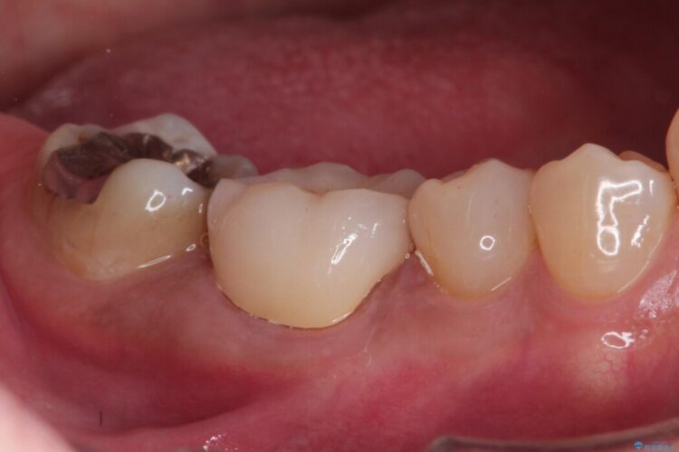 冷たいもので奥歯が痛む。精密根管治療とオールセラミッククラウン 治療後画像