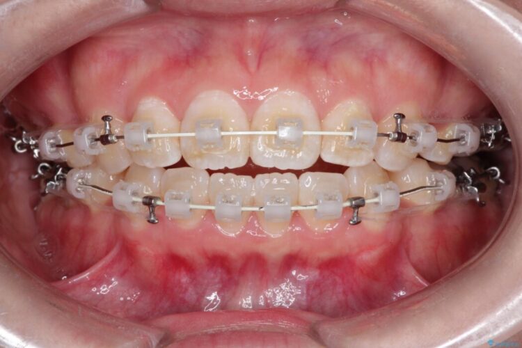 【上下顎前突】矯正歯科治療で口ゴボを治したい 治療途中画像