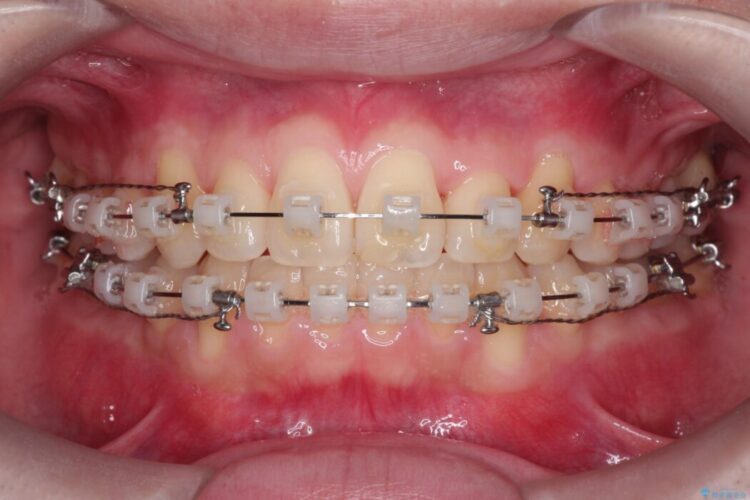 前歯の凸凹な歯並びをワイヤー矯正で綺麗に 治療途中画像
