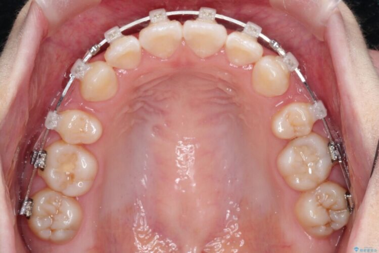 【上下顎前突】矯正歯科治療で口ゴボを治したい 治療途中画像