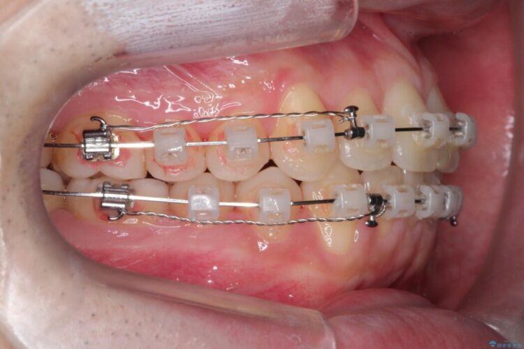 前歯の凸凹な歯並びをワイヤー矯正で綺麗に 治療途中画像