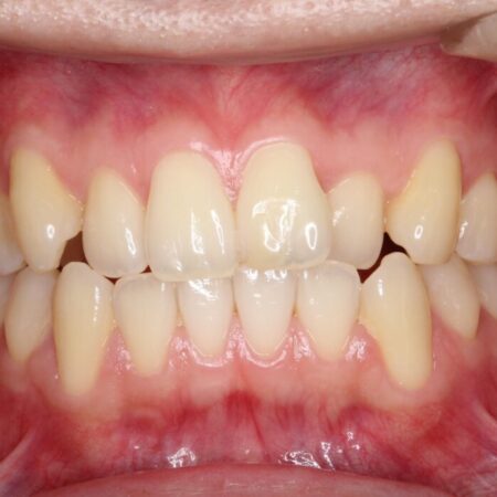 前歯の凸凹な歯並びをワイヤー矯正で綺麗に 治療前