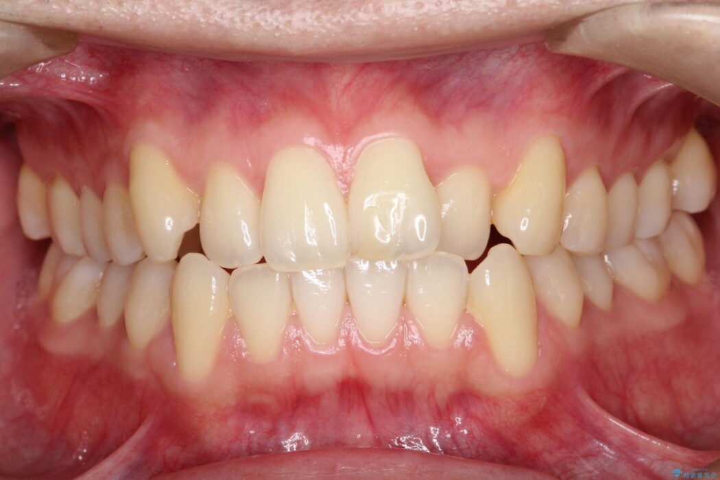 前歯の凸凹な歯並びをワイヤー矯正で綺麗に 治療前
