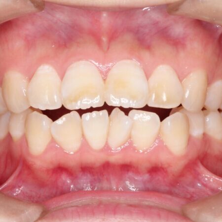 【上下顎前突】矯正歯科治療で口ゴボを治したい 治療前