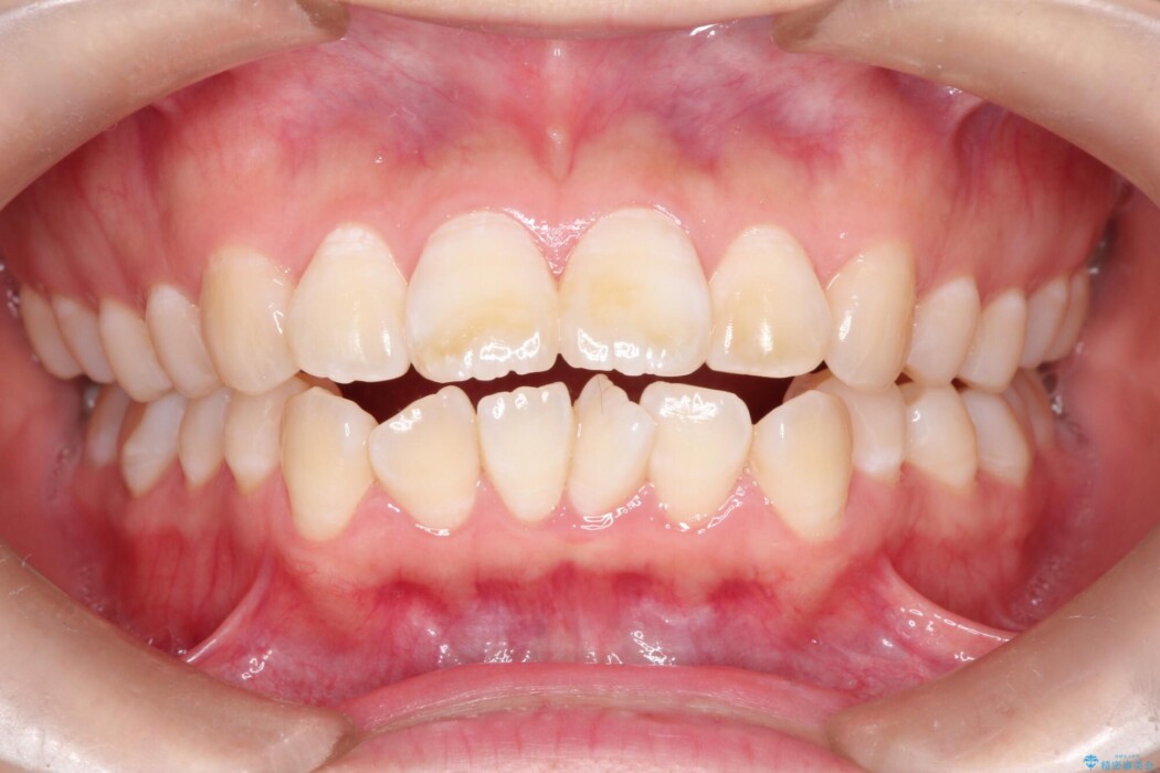 【上下顎前突】矯正歯科治療で口ゴボを治したい 治療前