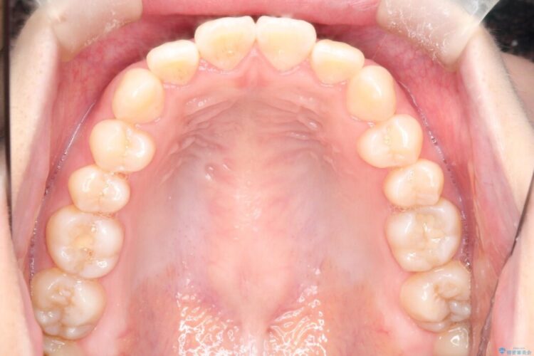 【上下顎前突】矯正歯科治療で口ゴボを治したい 治療前画像