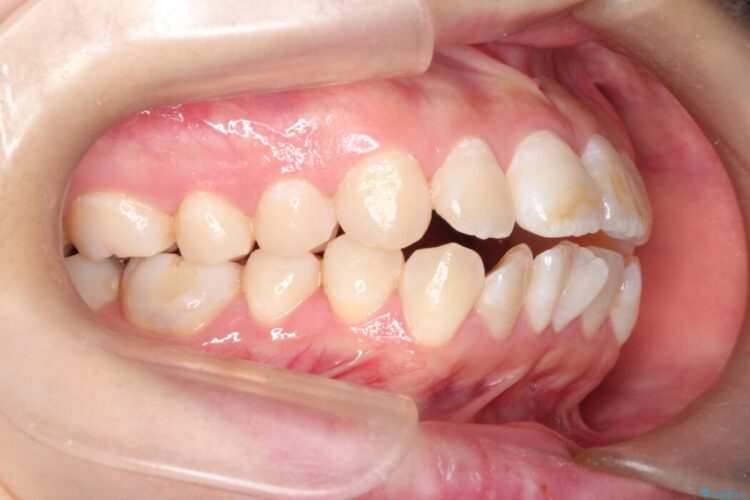 【上下顎前突】矯正歯科治療で口ゴボを治したい 治療前画像