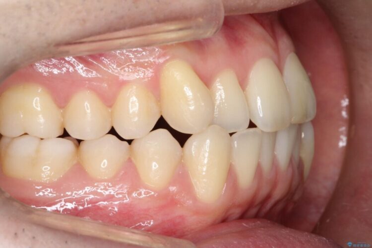 前歯の凸凹な歯並びをワイヤー矯正で綺麗に 治療前画像
