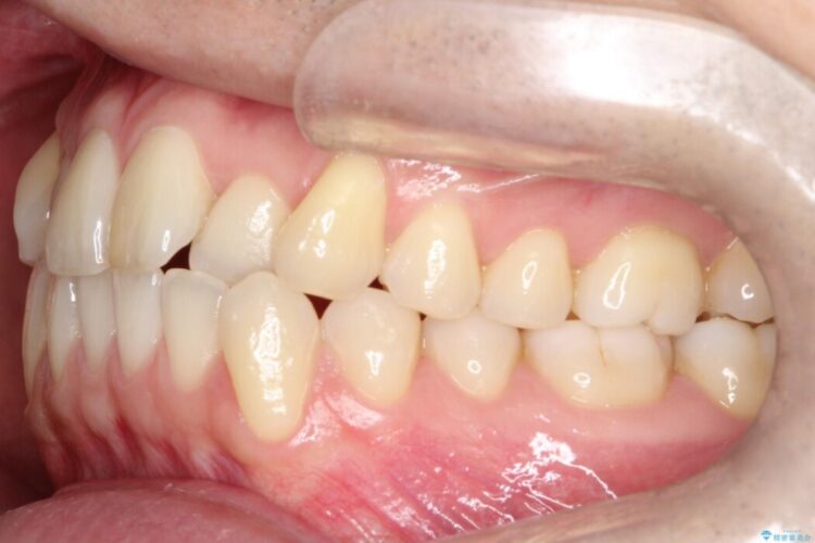 前歯の凸凹な歯並びをワイヤー矯正で綺麗に 治療前画像