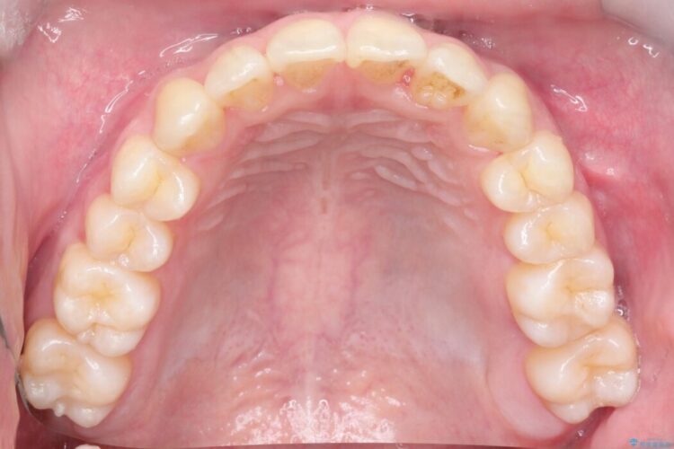 前歯の凸凹な歯並びをワイヤー矯正で綺麗に 治療後画像
