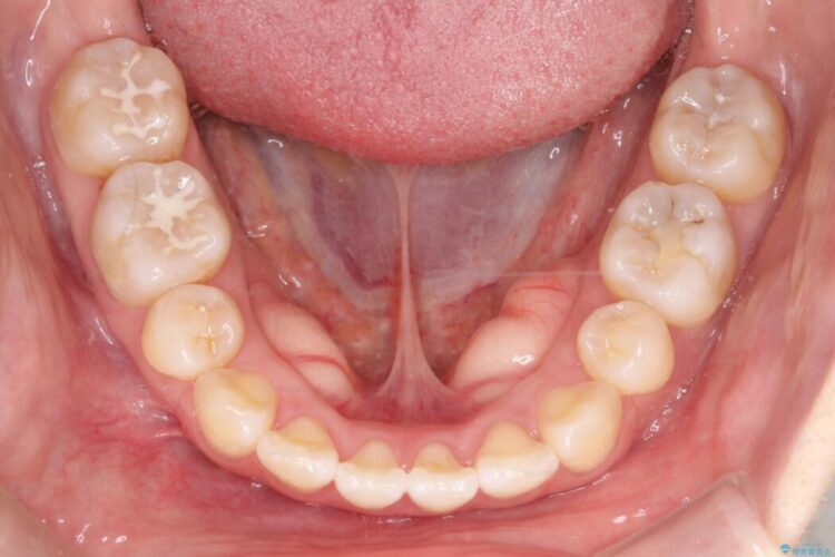 【上下顎前突】矯正歯科治療で口ゴボを治したい 治療後画像