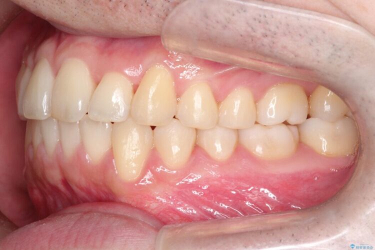 前歯の凸凹な歯並びをワイヤー矯正で綺麗に 治療後画像