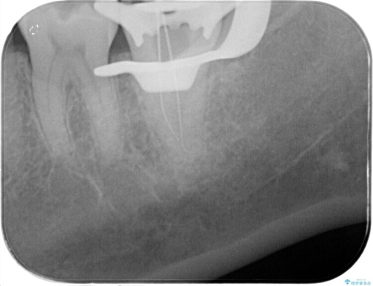 樋状根(といじょうこん)を根管治療 治療途中画像