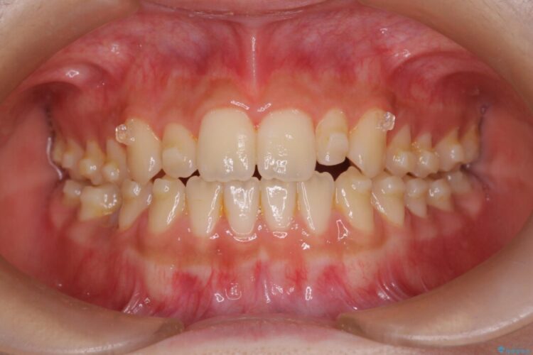 【インビザライン】未萌出の永久歯と八重歯をなおしたい。 治療途中画像