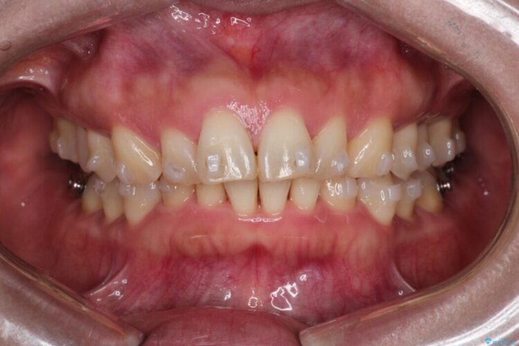 出っ歯をインビザラインで改善 治療途中画像
