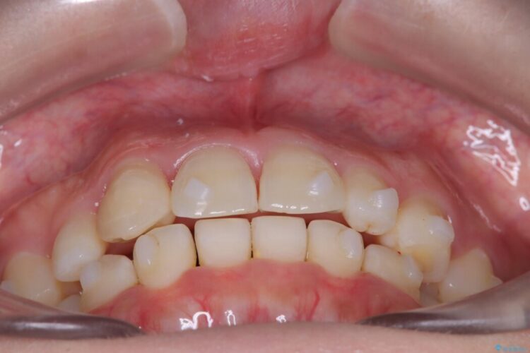 気になる飛び出た八重歯を歯科矯正で治したい 治療途中画像