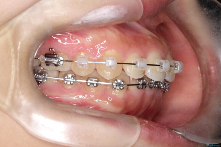 【ワイヤー矯正】前歯の叢生(ガタガタ)をなおす 治療途中画像