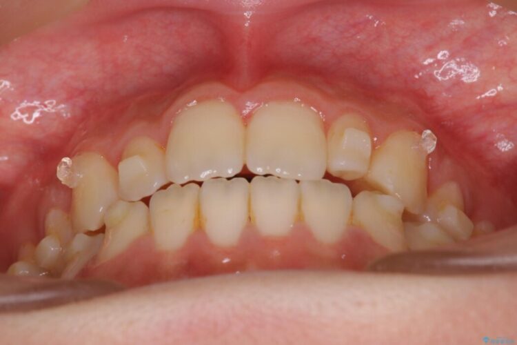 【インビザライン】未萌出の永久歯と八重歯をなおしたい。 治療途中画像