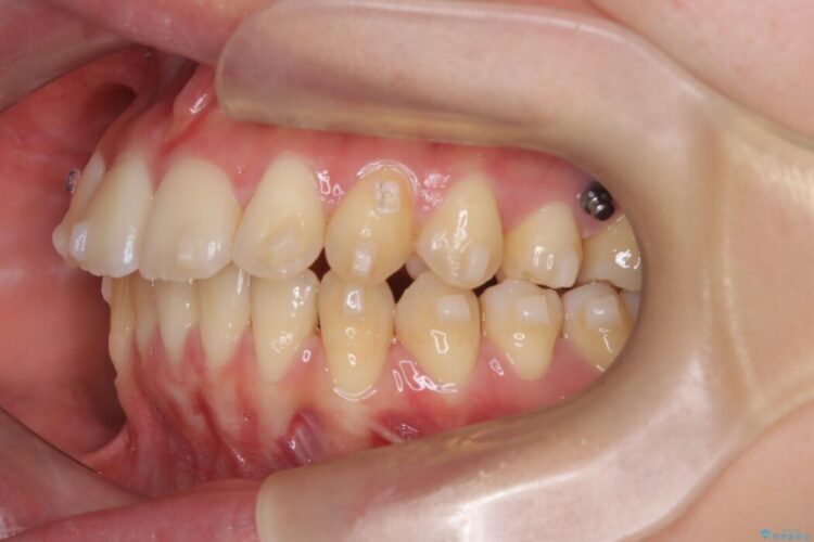 アンカースクリューを使用した前歯の遠心移動 治療途中画像
