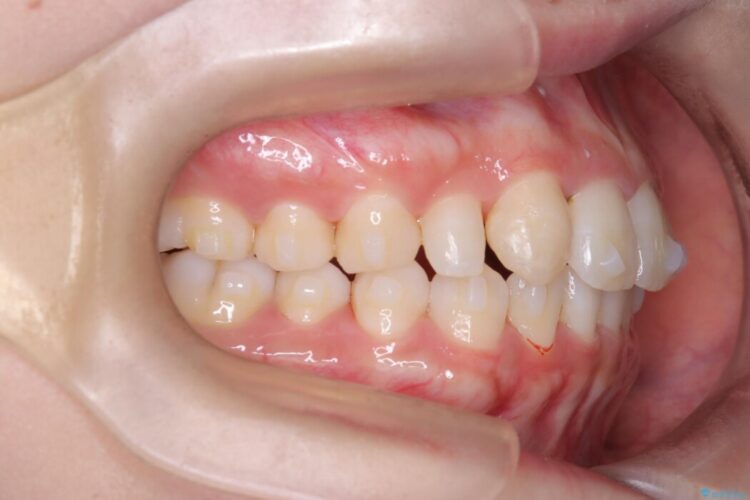 気になる飛び出た八重歯を歯科矯正で治したい 治療途中画像