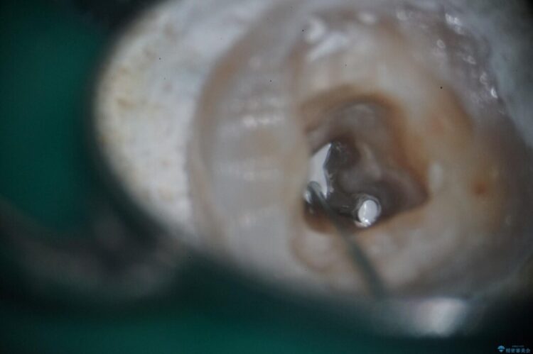 樋状根(といじょうこん)を根管治療 治療途中画像