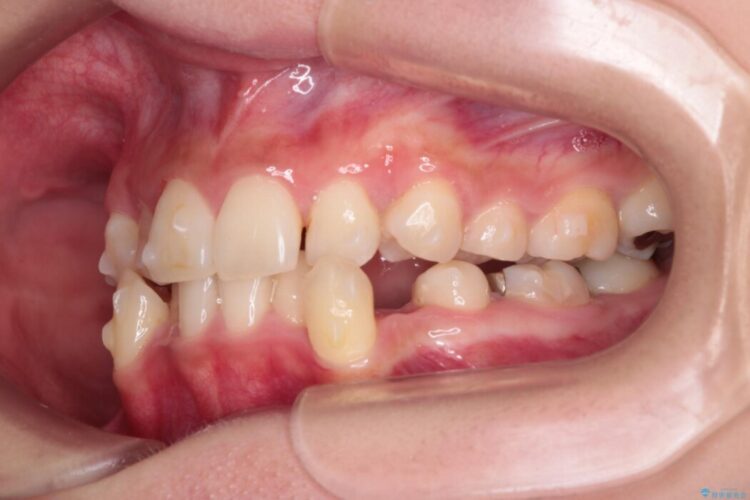 飛び出た犬歯と八重歯をなおしたい 治療途中画像