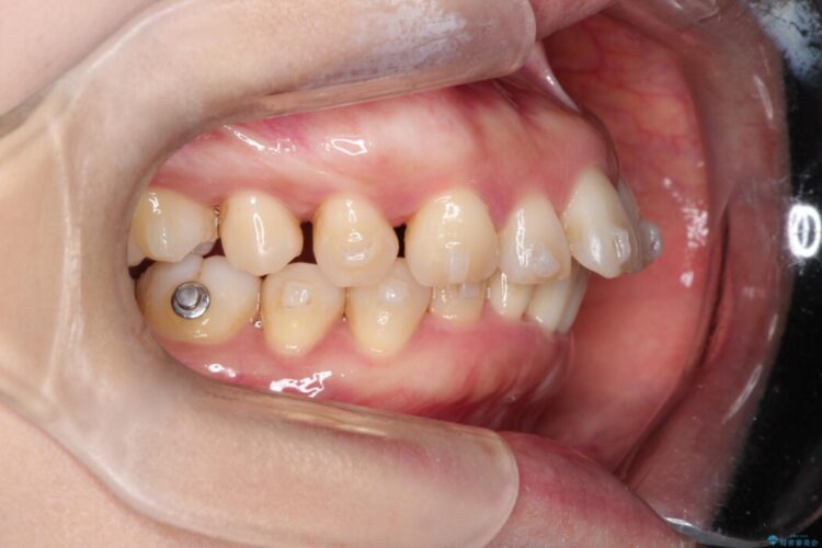 出っ歯をインビザラインで改善 治療途中画像