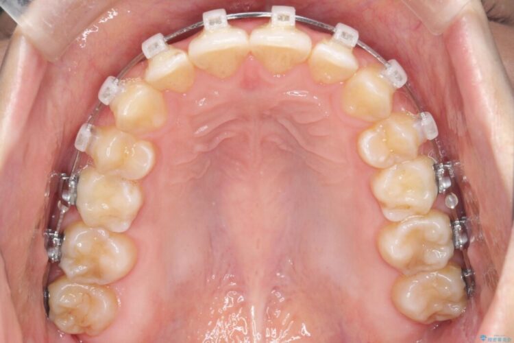 【ワイヤー矯正】前歯の叢生(ガタガタ)をなおす 治療途中画像