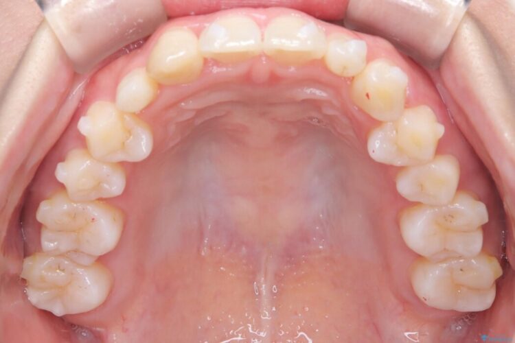 気になる飛び出た八重歯を歯科矯正で治したい 治療途中画像