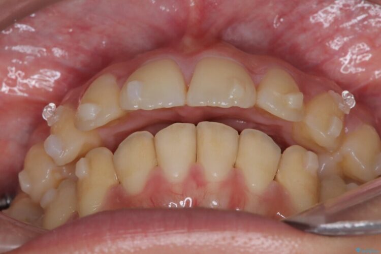 アンカースクリューを使用した前歯の遠心移動 治療途中画像