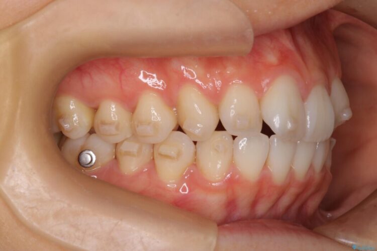 【インビザライン】前歯のねじれを改善 治療途中画像