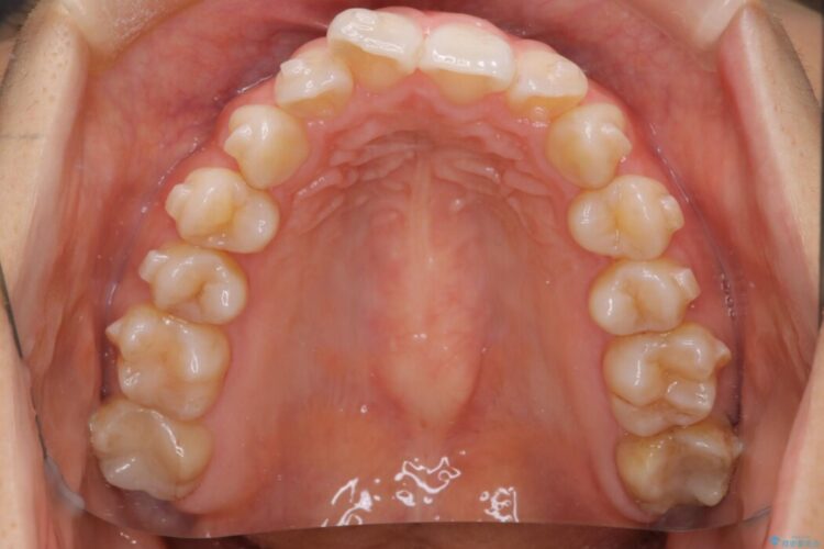 【インビザライン】前歯のねじれを改善 治療途中画像
