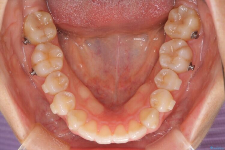 【インビザライン】前歯のねじれを改善 治療途中画像