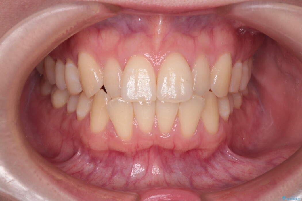 インビザラインによる反対咬合の改善 治療前
