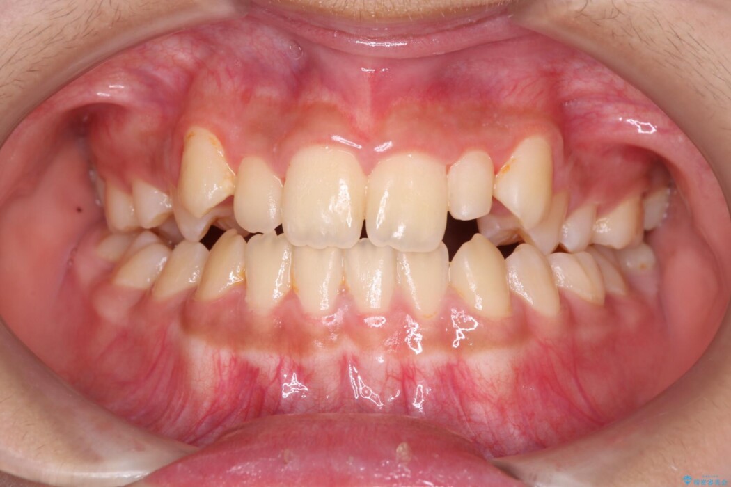 【インビザライン】未萌出の永久歯と八重歯をなおしたい。 治療前