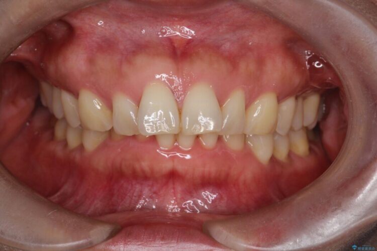 出っ歯をインビザラインで改善 治療前画像