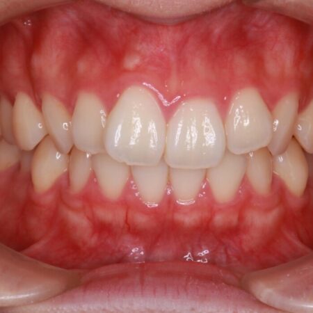 【インビザライン】前歯のねじれを改善 治療前