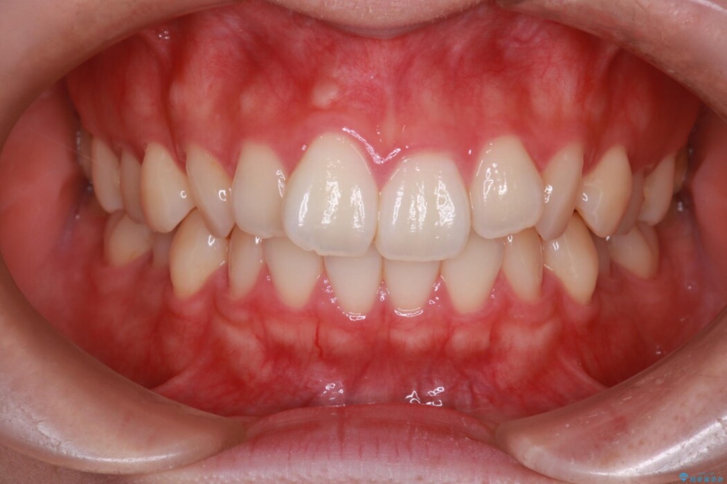 【インビザライン】前歯のねじれを改善 治療前