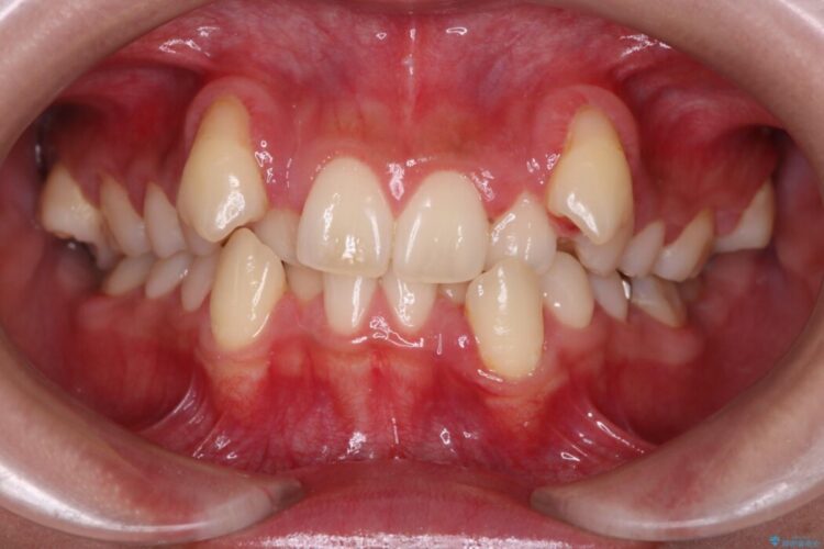 飛び出た犬歯と八重歯をなおしたい 治療前画像