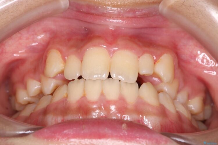 【インビザライン】未萌出の永久歯と八重歯をなおしたい。 治療前画像