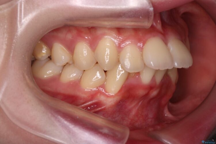 アンカースクリューを使用した前歯の遠心移動 治療前画像