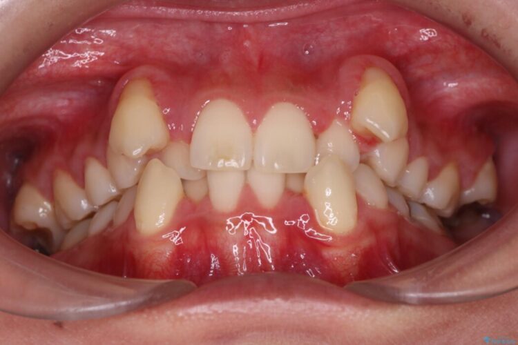 飛び出た犬歯と八重歯をなおしたい 治療前画像