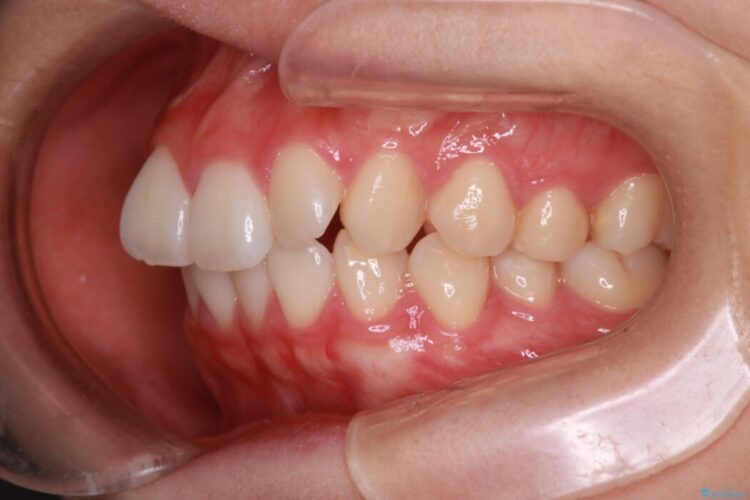 【インビザライン】前歯のねじれを改善 治療前画像