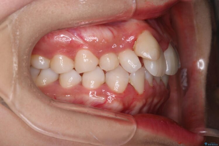 気になる飛び出た八重歯を歯科矯正で治したい 治療前画像