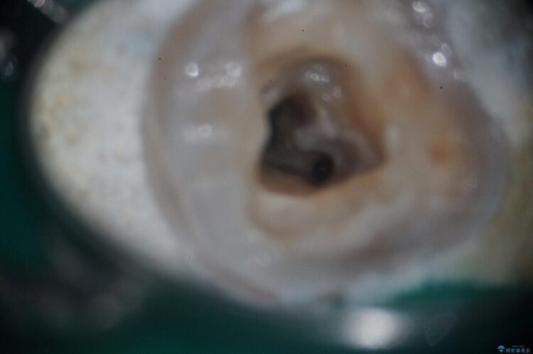 樋状根(といじょうこん)を根管治療 治療前画像