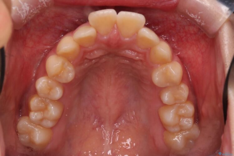 アンカースクリューを使用した前歯の遠心移動 治療前画像