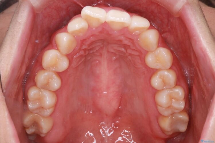 【インビザライン】前歯のねじれを改善 治療前画像